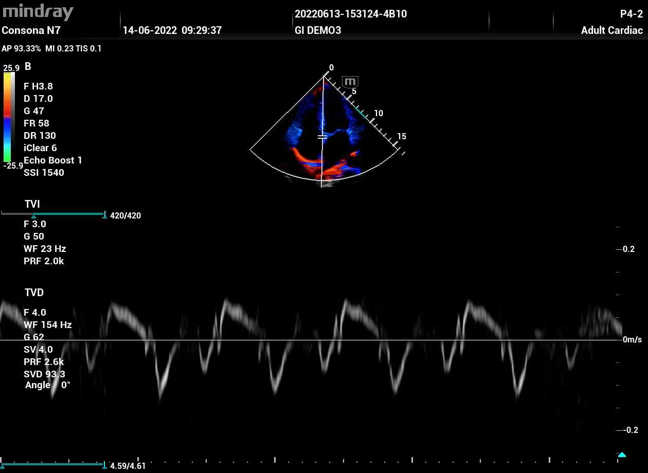 УЗИ аппарат Mindray Consona N72
