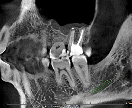 Genoray Papaya 3D 16x14 – дентальный компьютерный 3D-томограф2