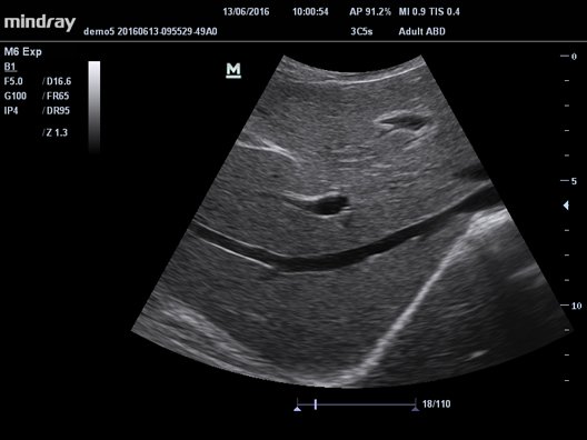 УЗИ аппарат Mindray M64