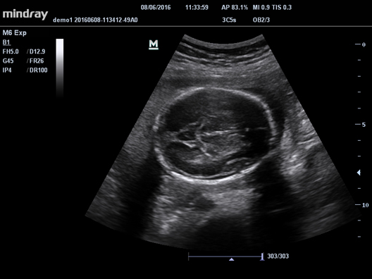 УЗИ аппарат Mindray M61