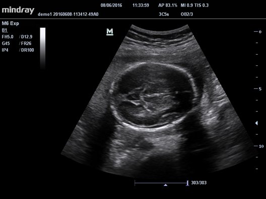 УЗИ аппарат Mindray M61