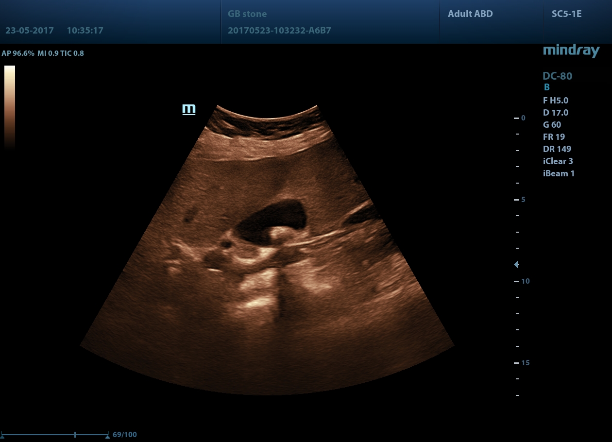 УЗИ аппарат Mindray DC-802