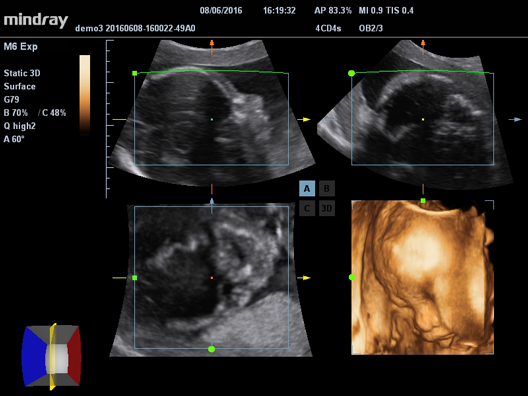 УЗИ аппарат Mindray M62