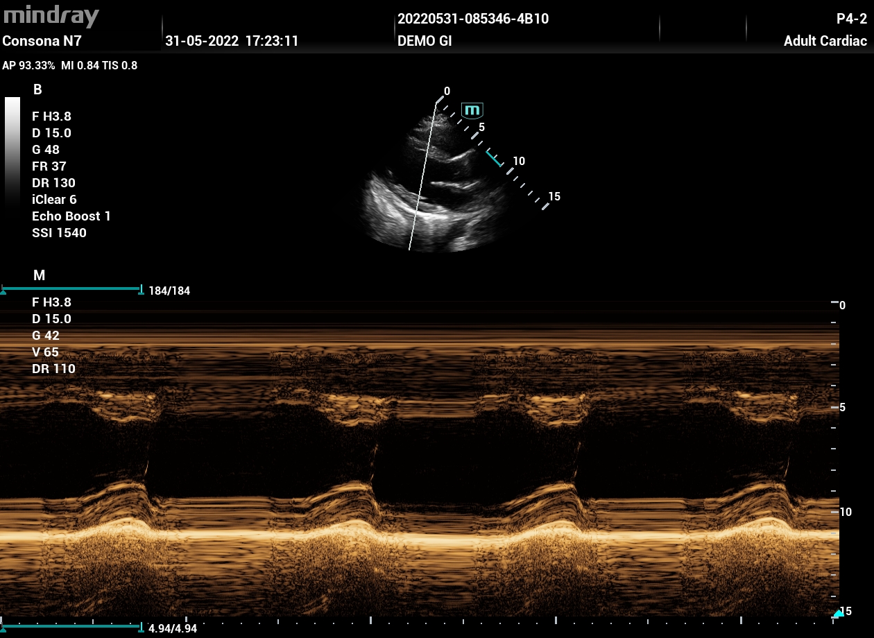 УЗИ аппарат Mindray Consona N71