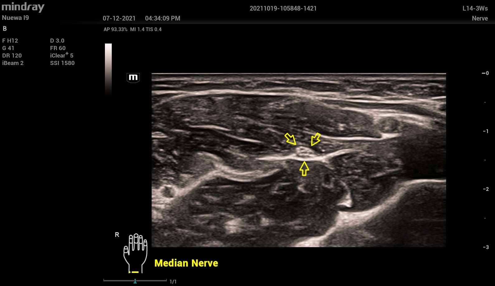 УЗИ Mindray Resona I92