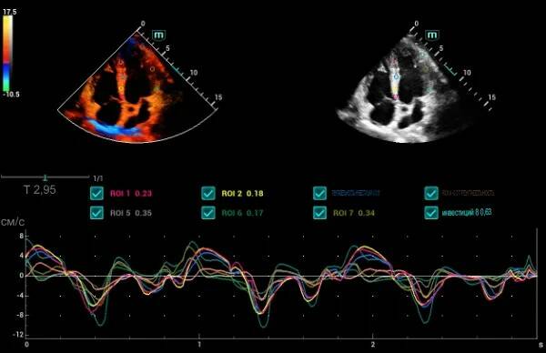 УЗИ аппарат Mindray Consona N84 УЗИ аппарат Mindray Consona N84