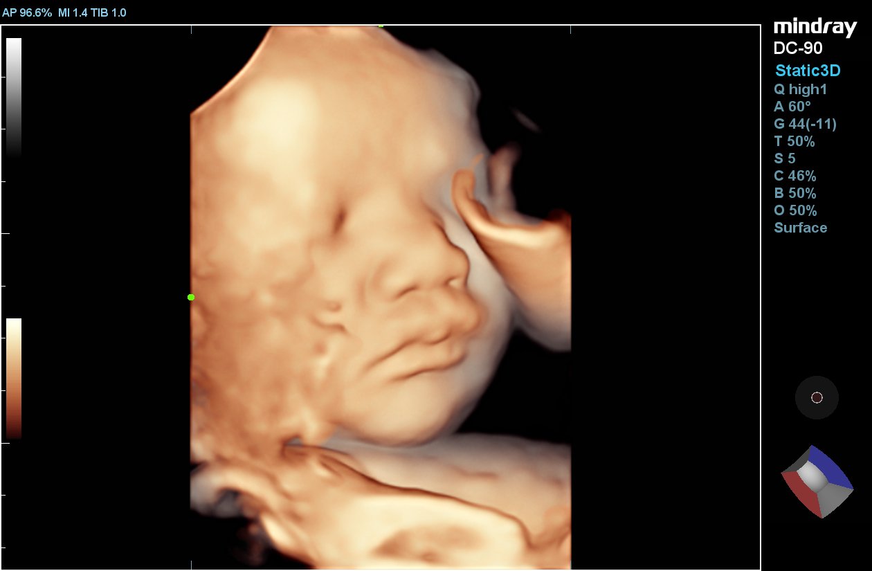 УЗИ аппарат Mindray DC-90 X-insight 4