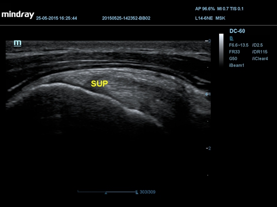 УЗИ аппарат Mindray DC-60 Pro X-Insight3