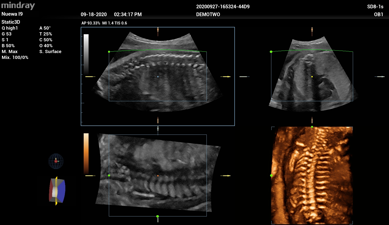 УЗИ аппарат Mindray Imagyn I93
