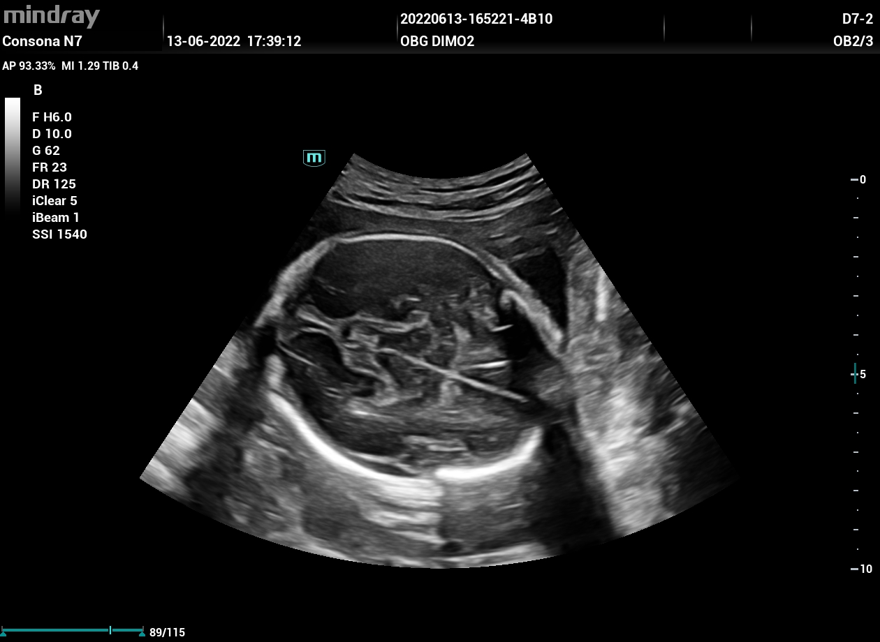 УЗИ аппарат Mindray Consona N73