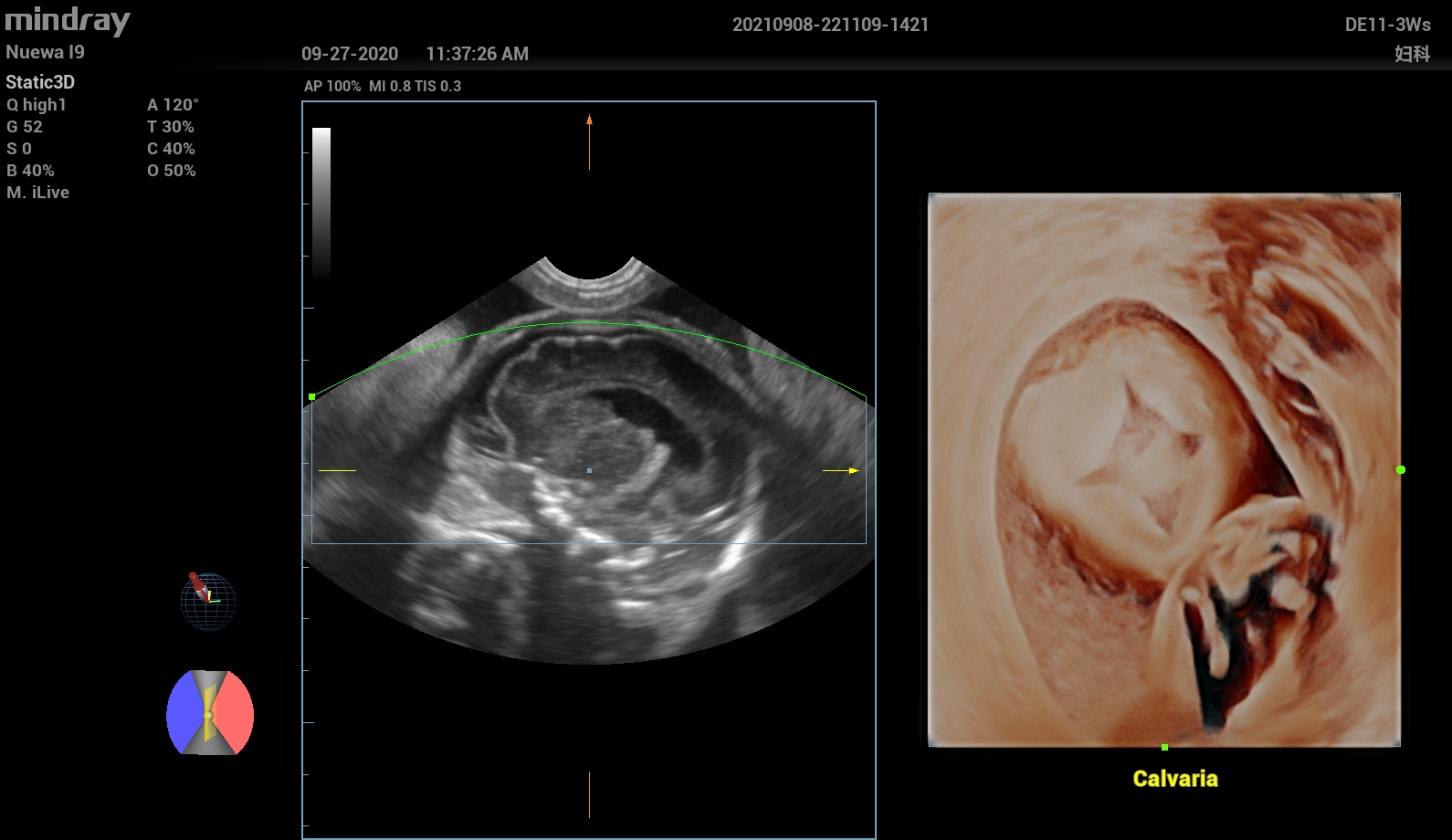 УЗИ аппарат Mindray Imagyn I92