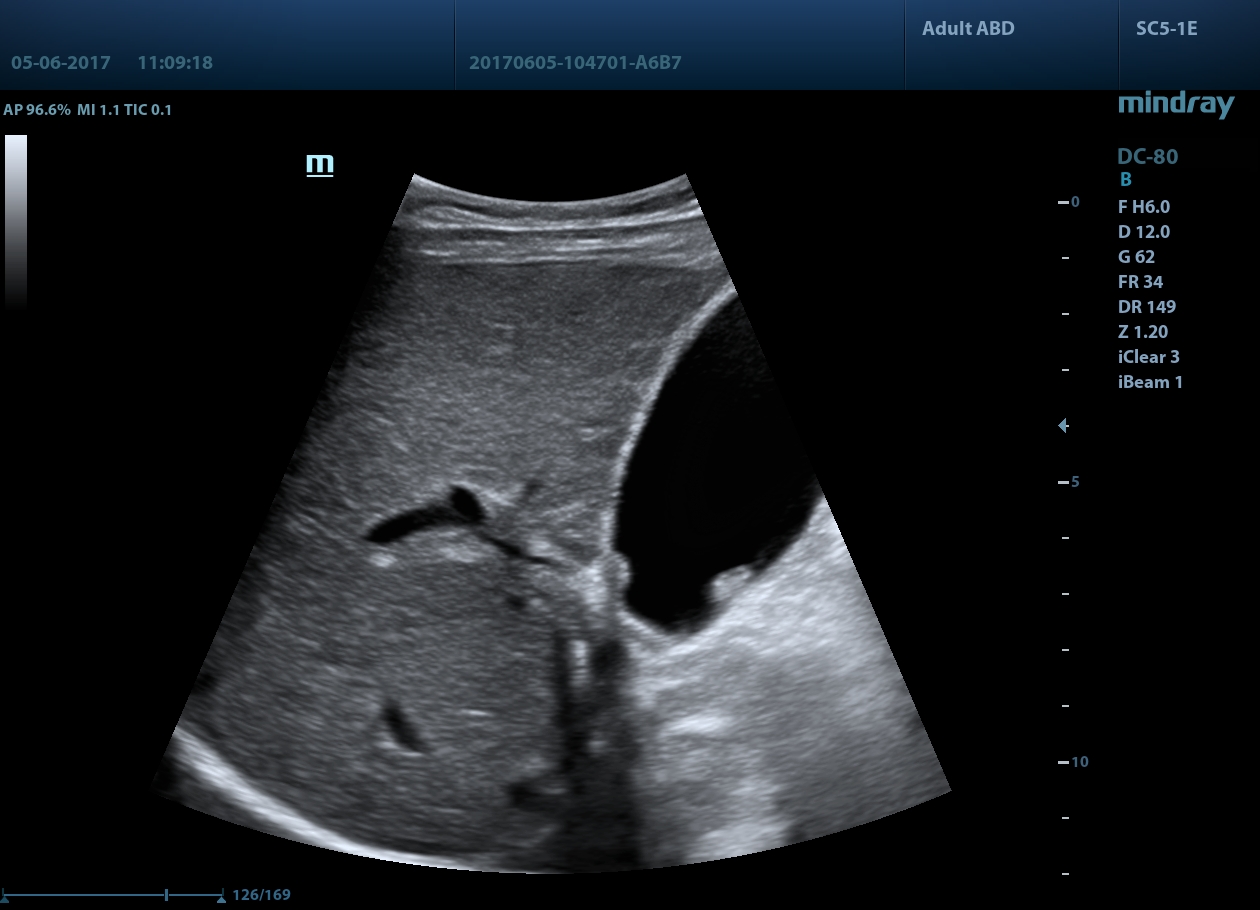 УЗИ аппарат Mindray DC-801