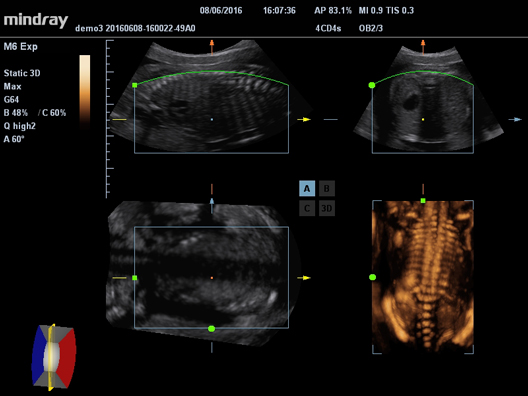 УЗИ аппарат Mindray M63