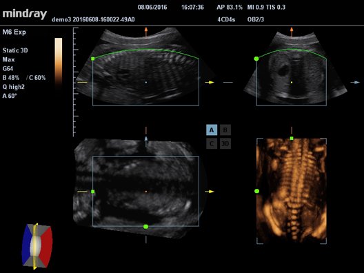 УЗИ аппарат Mindray M63