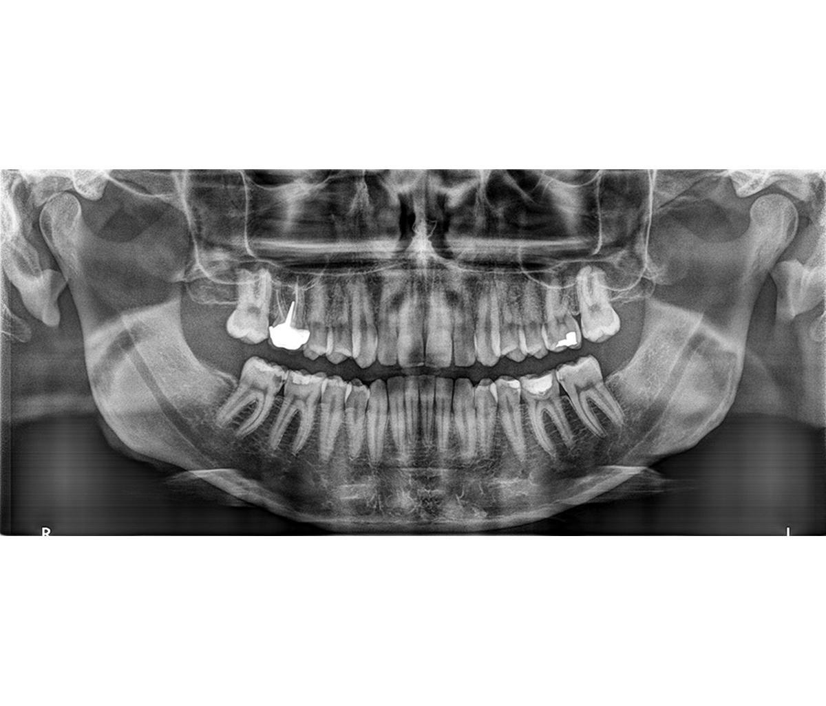 Панорамный рентгеновский аппарат Carestream Dental CS 8100 2D3