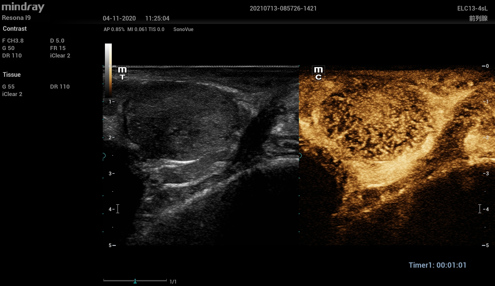 УЗИ Mindray Resona I93