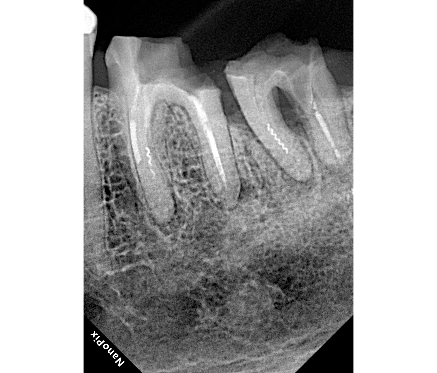 Визиограф интраоральный Eighteeth Nanopix 16