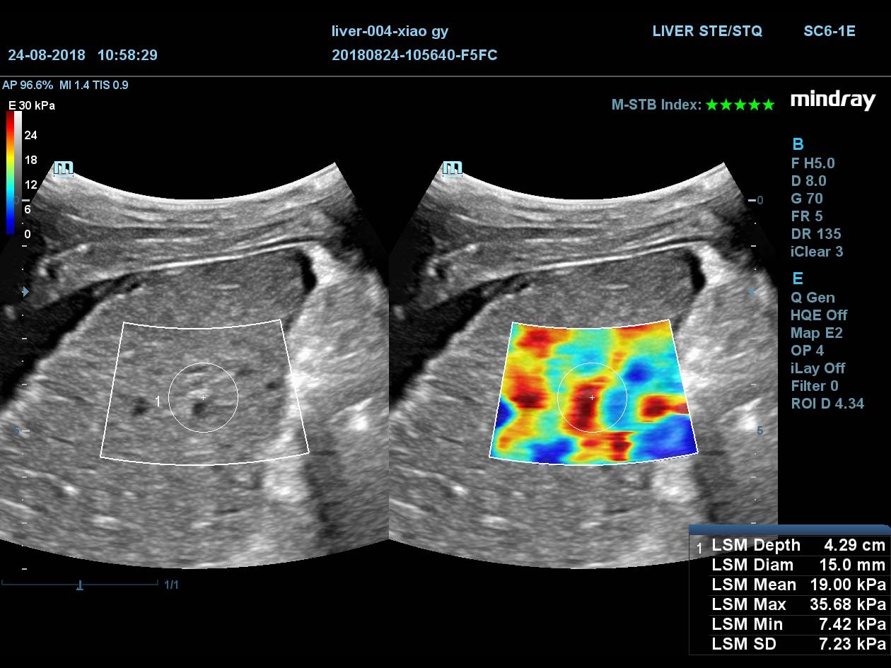 УЗИ аппарат Mindray DC-90 X-insight 2